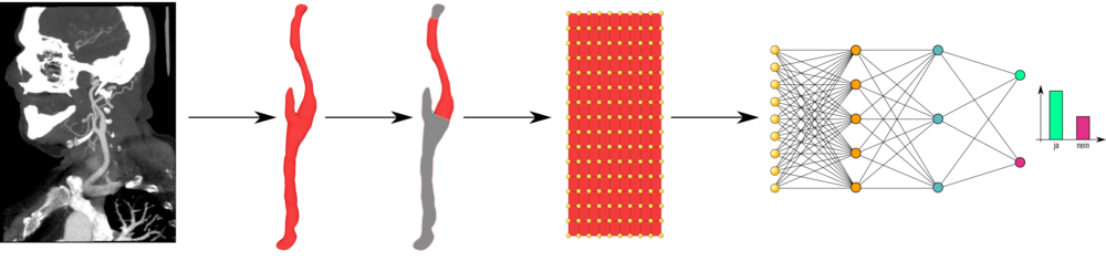 Schematische Darstellung des Übergangs von Röntgenbildern zu Vermessung von Blutgefässen zu Modellierung zur Numerischen Simulation zur medizinischen Entscheidung